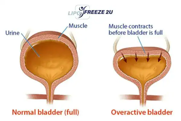 diagram of overactive bladder treatment Wellingborough