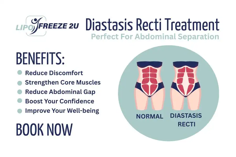 How Long Will It Take to See Improvements in Diastasis Recti Wellingborough