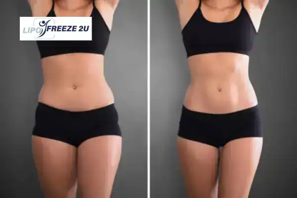 How Can LIPO FREEZE 2U Support Your Post-Pregnancy Body Recovery Wellingborough?