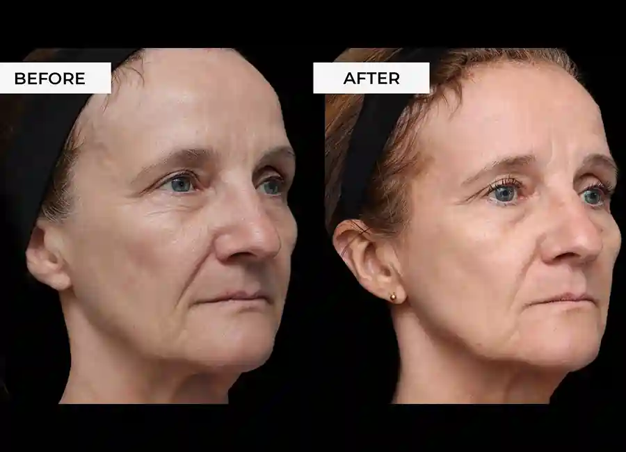 How Many RF Microneedling Sessions Will You Need to See a Difference Wellingborough?