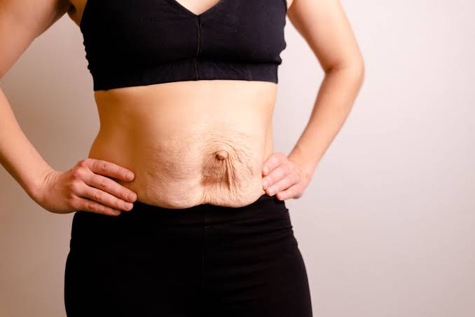 Is Surgery Really the Only Way to Repair Diastasis Recti Wellingborough?