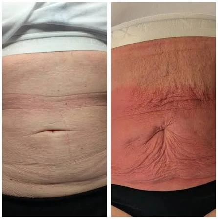 How Does RF Microneedling Improve Crepey, Thin and Uneven Skin Texture Wellingborough?