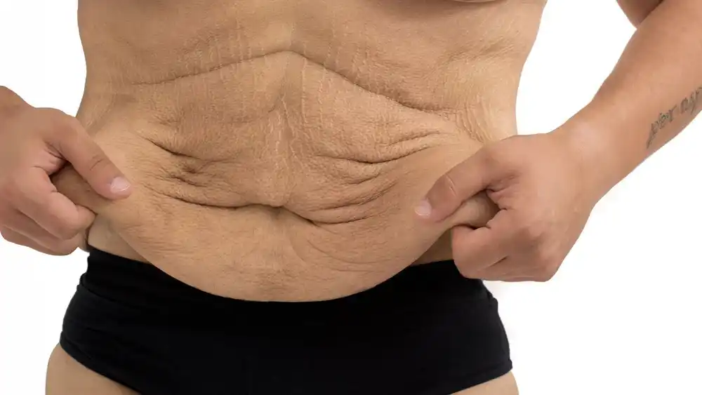Why Does Weight Loss Medication Leave Some People With Loose or Sagging Skin Wellingborough?